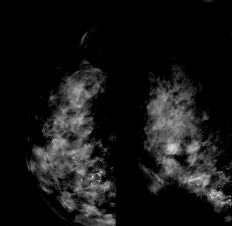 数字化摄影是什么检查好消息！助力乳腺癌早期诊断 青田人民医院数字化乳腺X线机正式投入使用_https://www.jmylbn.com_新闻资讯_第14张