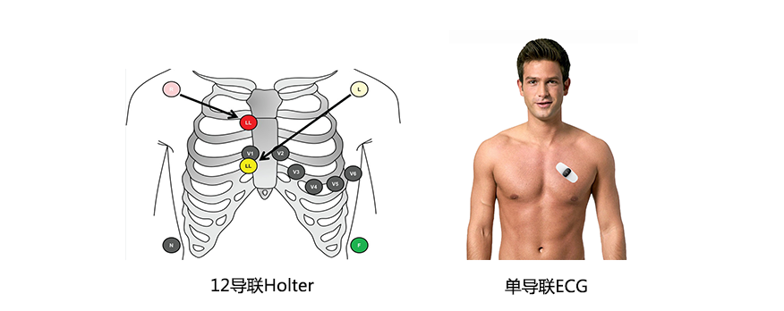 心电图12导怎么组成心研单导ECG与12导Holter对比分析_https://www.jmylbn.com_新闻资讯_第4张