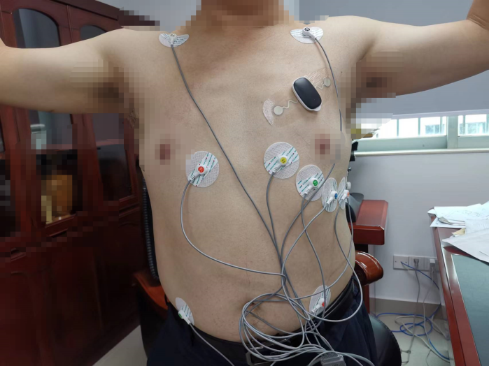 心电图12导怎么组成心研单导ECG与12导Holter对比分析_https://www.jmylbn.com_新闻资讯_第3张