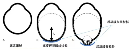 后巩膜加固术 — 加固带示意