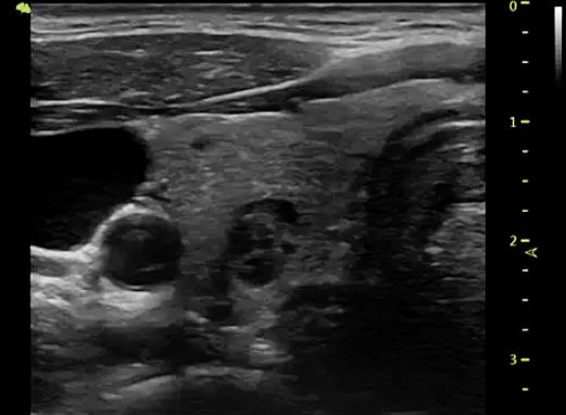 微波治疗机怎么使用多模态超微创微波消融技术治疗甲状腺疾病，实现微创、无痕、保腺体！_https://www.jmylbn.com_新闻资讯_第3张