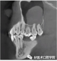 一文读懂与上颌窦提升术相关的上颌窦囊性病变！