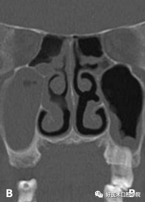 一文读懂与上颌窦提升术相关的上颌窦囊性病变！