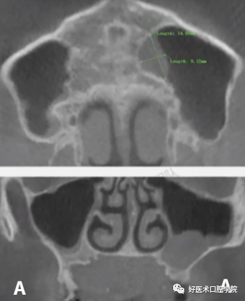 一文读懂与上颌窦提升术相关的上颌窦囊性病变！
