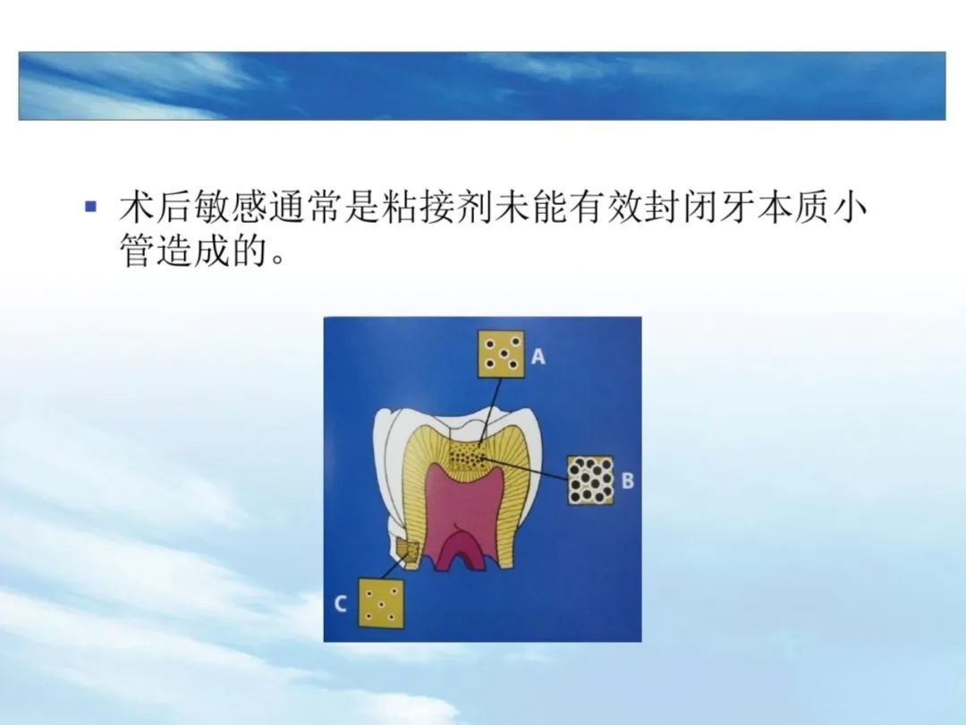 树脂充填后敏感的原因，这几点不可忽略！