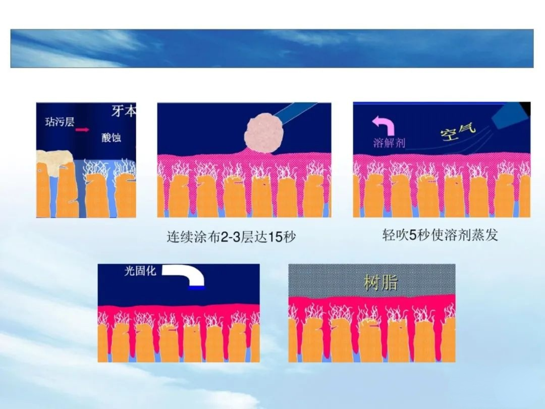 树脂充填后敏感的原因，这几点不可忽略！