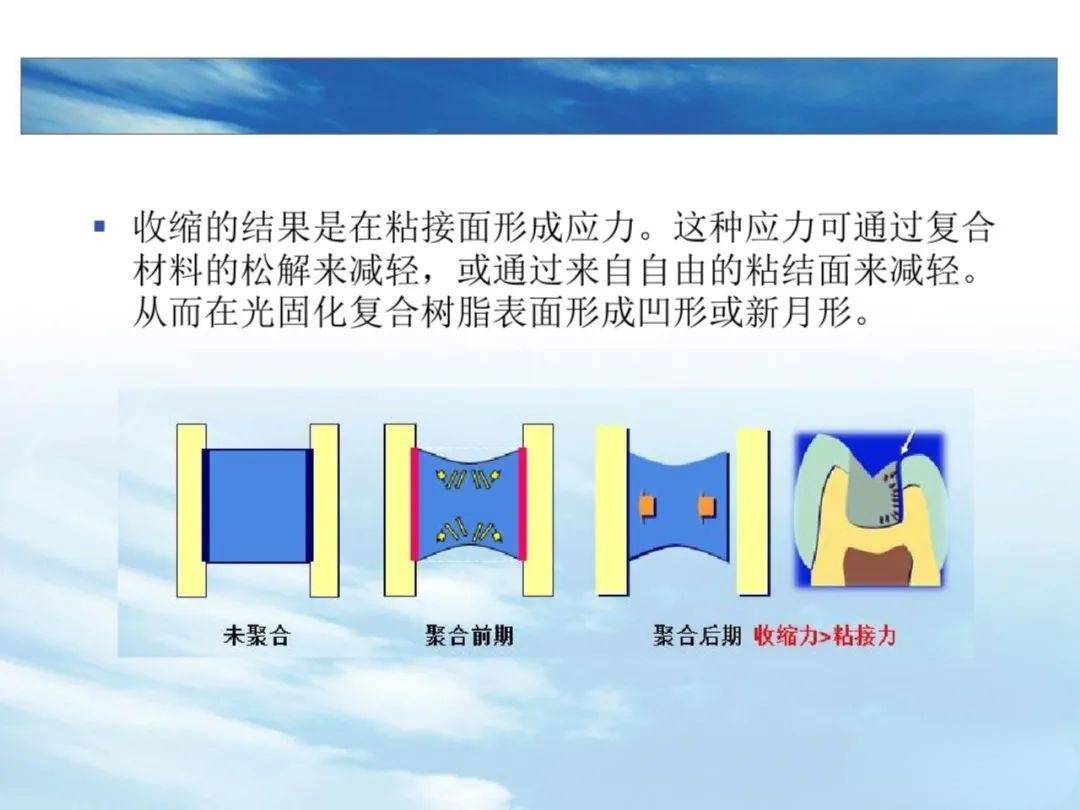 树脂充填后敏感的原因，这几点不可忽略！