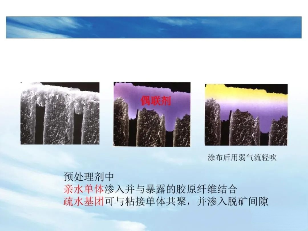 树脂充填后敏感的原因，这几点不可忽略！