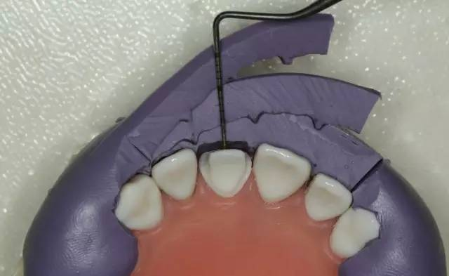 牙科材料硅胶怎么用牙体预备步骤详解，手把手教你制作硅橡胶导板！_https://www.jmylbn.com_新闻资讯_第23张