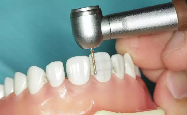 牙科材料硅胶怎么用牙体预备步骤详解，手把手教你制作硅橡胶导板！_https://www.jmylbn.com_新闻资讯_第14张