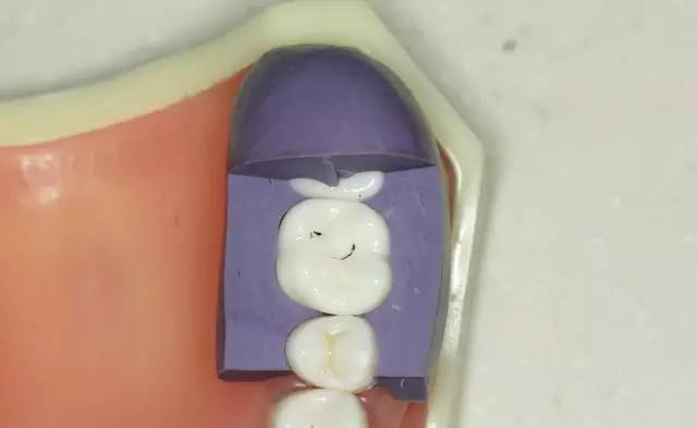 牙科材料硅胶怎么用牙体预备步骤详解，手把手教你制作硅橡胶导板！_https://www.jmylbn.com_新闻资讯_第28张