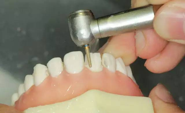 牙科材料硅胶怎么用牙体预备步骤详解，手把手教你制作硅橡胶导板！_https://www.jmylbn.com_新闻资讯_第16张