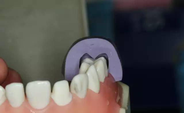 牙科材料硅胶怎么用牙体预备步骤详解，手把手教你制作硅橡胶导板！_https://www.jmylbn.com_新闻资讯_第35张