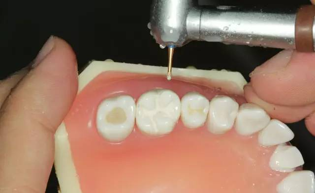 牙科材料硅胶怎么用牙体预备步骤详解，手把手教你制作硅橡胶导板！_https://www.jmylbn.com_新闻资讯_第30张