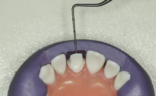 牙科材料硅胶怎么用牙体预备步骤详解，手把手教你制作硅橡胶导板！_https://www.jmylbn.com_新闻资讯_第21张