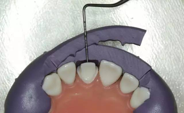 牙科材料硅胶怎么用牙体预备步骤详解，手把手教你制作硅橡胶导板！_https://www.jmylbn.com_新闻资讯_第22张