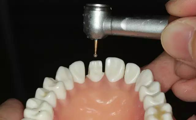 牙科材料硅胶怎么用牙体预备步骤详解，手把手教你制作硅橡胶导板！_https://www.jmylbn.com_新闻资讯_第17张