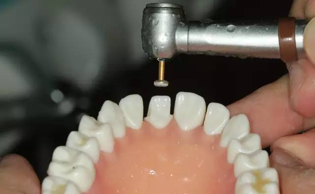 牙科材料硅胶怎么用牙体预备步骤详解，手把手教你制作硅橡胶导板！_https://www.jmylbn.com_新闻资讯_第18张