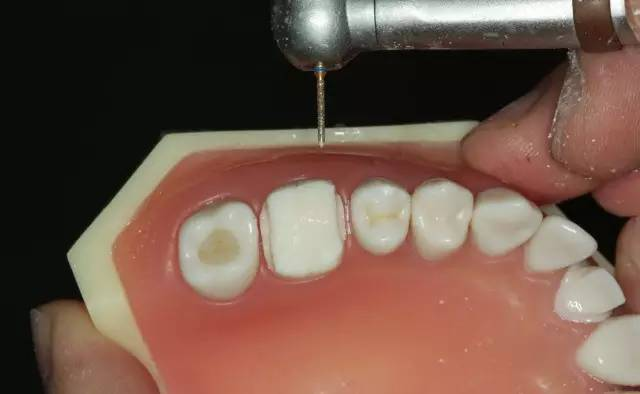 牙科材料硅胶怎么用牙体预备步骤详解，手把手教你制作硅橡胶导板！_https://www.jmylbn.com_新闻资讯_第31张