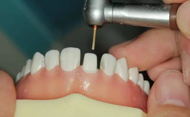 牙科材料硅胶怎么用牙体预备步骤详解，手把手教你制作硅橡胶导板！_https://www.jmylbn.com_新闻资讯_第19张