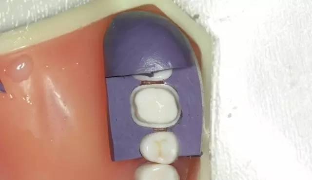 牙科材料硅胶怎么用牙体预备步骤详解，手把手教你制作硅橡胶导板！_https://www.jmylbn.com_新闻资讯_第34张