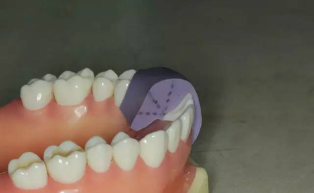 牙科材料硅胶怎么用牙体预备步骤详解，手把手教你制作硅橡胶导板！_https://www.jmylbn.com_新闻资讯_第7张
