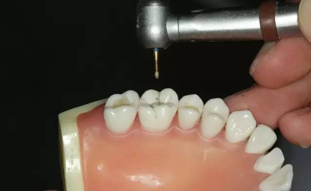 牙科材料硅胶怎么用牙体预备步骤详解，手把手教你制作硅橡胶导板！_https://www.jmylbn.com_新闻资讯_第29张