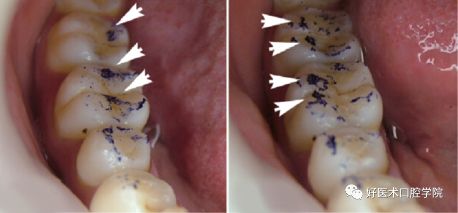 牙胶尖什么颜色早读 ｜ 几十年牙医总结临床经验，现在只需几分钟便可全部了解！_https://www.jmylbn.com_新闻资讯_第2张