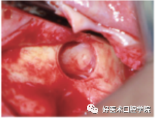 一文读懂与上颌窦提升术相关的上颌窦囊性病变！