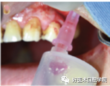 一文读懂与上颌窦提升术相关的上颌窦囊性病变！