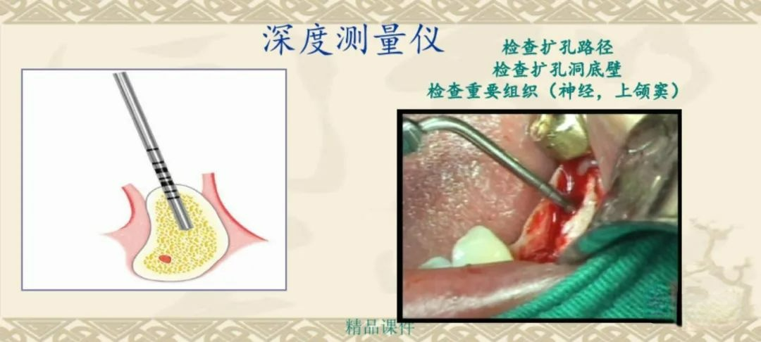 甲状腺拉钩怎么用早读 ｜ 盘点口腔种植手术器械，一文告诉你怎么使用！_https://www.jmylbn.com_新闻资讯_第32张