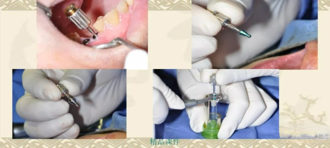 甲状腺拉钩怎么用早读 ｜ 盘点口腔种植手术器械，一文告诉你怎么使用！_https://www.jmylbn.com_新闻资讯_第43张