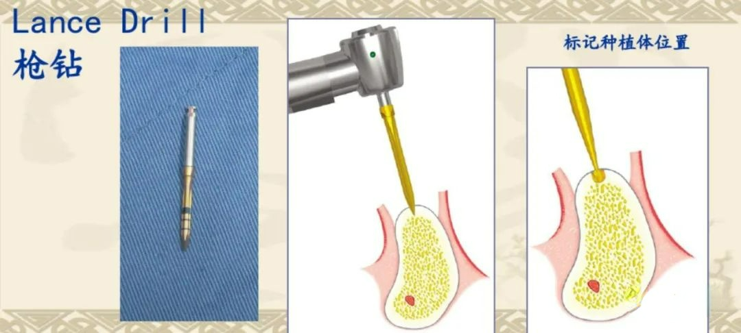 甲状腺拉钩怎么用早读 ｜ 盘点口腔种植手术器械，一文告诉你怎么使用！_https://www.jmylbn.com_新闻资讯_第18张