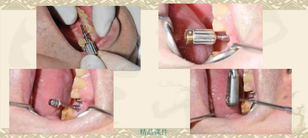 甲状腺拉钩怎么用早读 ｜ 盘点口腔种植手术器械，一文告诉你怎么使用！_https://www.jmylbn.com_新闻资讯_第44张