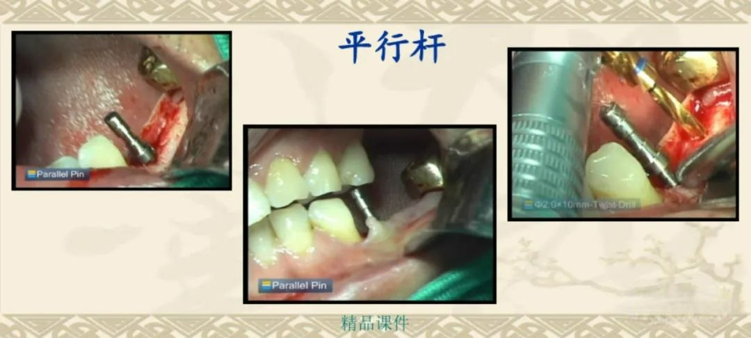 甲状腺拉钩怎么用早读 ｜ 盘点口腔种植手术器械，一文告诉你怎么使用！_https://www.jmylbn.com_新闻资讯_第30张