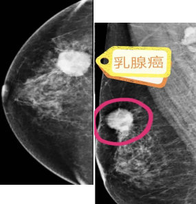 数字钼靶是什么关注女性健康，乳腺检查的首选——数字化乳腺钼靶_https://www.jmylbn.com_新闻资讯_第10张