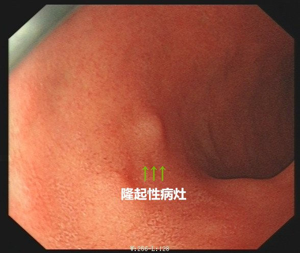 什么是超声容积探头新技术 ｜ 胃肠不好怕检查？别怕！胃肠充盈超声造影检查新方法来帮您_https://www.jmylbn.com_新闻资讯_第12张