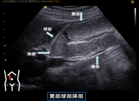 什么是超声容积探头新技术 ｜ 胃肠不好怕检查？别怕！胃肠充盈超声造影检查新方法来帮您_https://www.jmylbn.com_新闻资讯_第10张