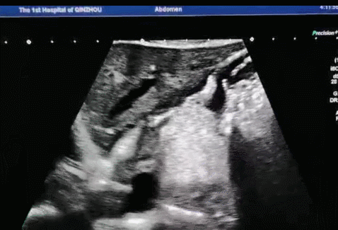 什么是超声容积探头新技术 ｜ 胃肠不好怕检查？别怕！胃肠充盈超声造影检查新方法来帮您_https://www.jmylbn.com_新闻资讯_第14张