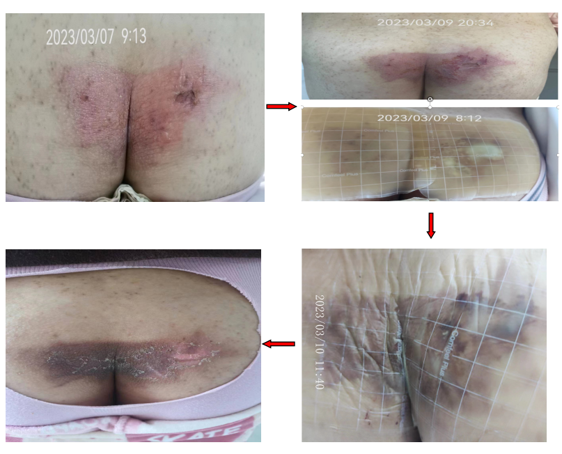 升温毯费用怎么开剖腹产术后：压力性损伤还是低温烫伤？_https://www.jmylbn.com_新闻资讯_第7张