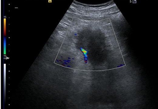胰腺癌彩超图片