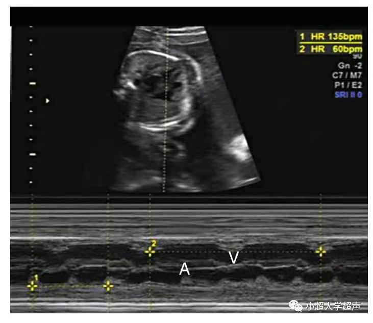 胎儿超声心电图是什么超声小视角之胎儿房室传导阻滞_https://www.jmylbn.com_新闻资讯_第6张