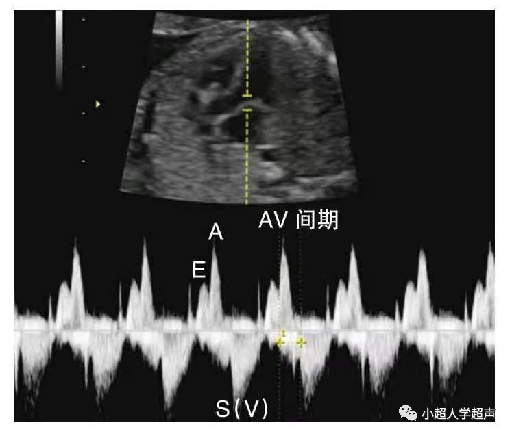 胎儿超声心电图是什么超声小视角之胎儿房室传导阻滞_https://www.jmylbn.com_新闻资讯_第2张
