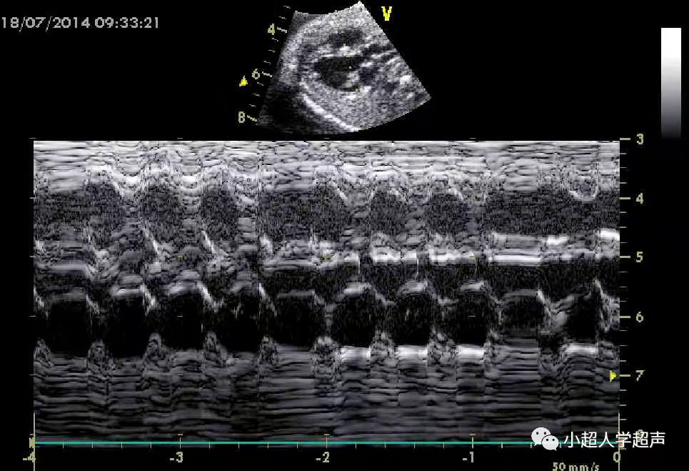胎儿超声心电图是什么超声小视角之胎儿房室传导阻滞_https://www.jmylbn.com_新闻资讯_第5张