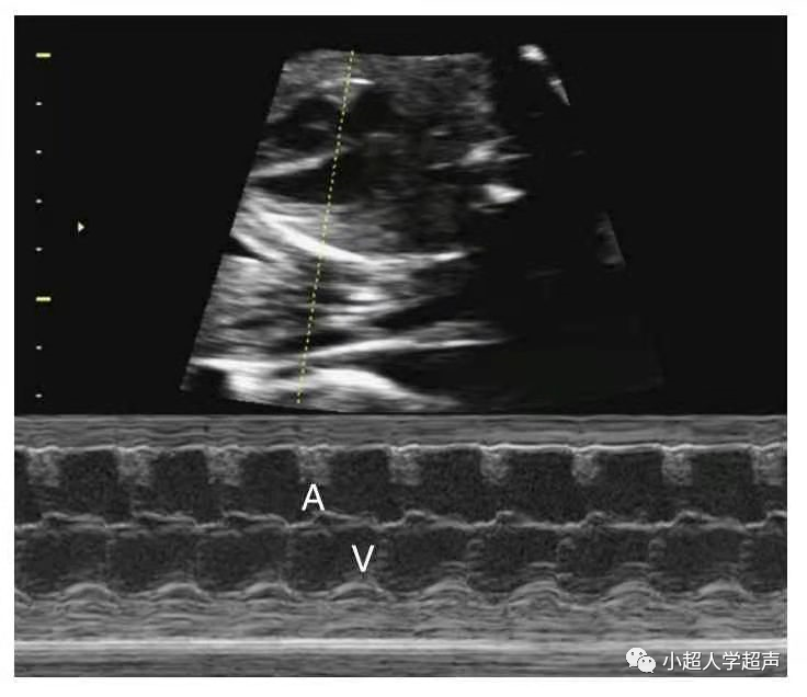 胎儿超声心电图是什么超声小视角之胎儿房室传导阻滞_https://www.jmylbn.com_新闻资讯_第1张