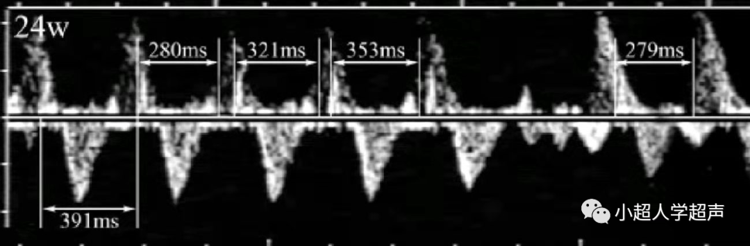 胎儿超声心电图是什么超声小视角之胎儿房室传导阻滞_https://www.jmylbn.com_新闻资讯_第4张