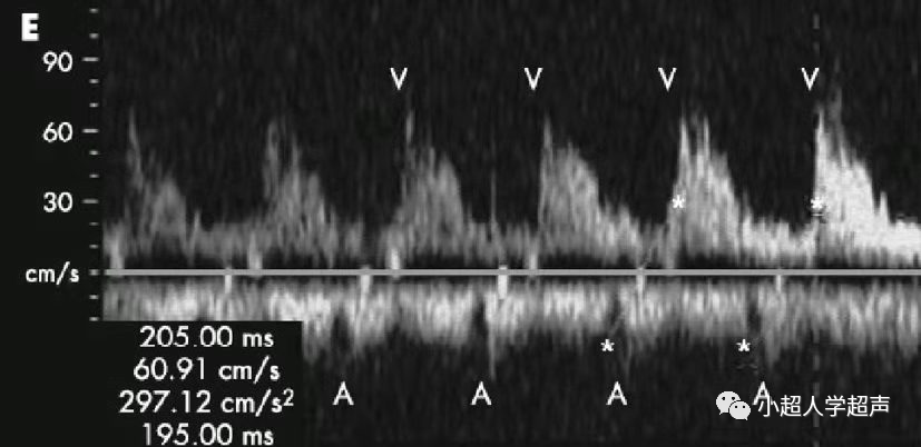 胎儿超声心电图是什么超声小视角之胎儿房室传导阻滞_https://www.jmylbn.com_新闻资讯_第3张