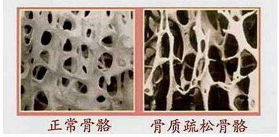 双能x骨密度检测仪为什么非得输入体重身高双能X线（DXA）骨密度检测及报告解读_https://www.jmylbn.com_新闻资讯_第6张