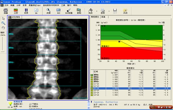 双能x骨密度检测仪为什么非得输入体重身高双能X线（DXA）骨密度检测及报告解读_https://www.jmylbn.com_新闻资讯_第9张