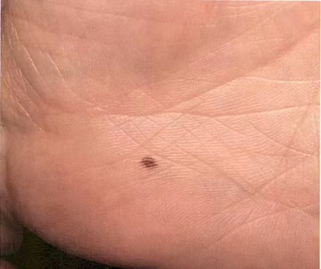 电子皮肤镜有什么用松医电子皮肤镜正式投入使用_https://www.jmylbn.com_新闻资讯_第3张